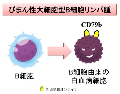 びまん性大細胞型B細胞リンパ腫（DLBCL）とCD79b