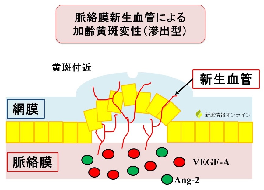 加齢黄斑変性と新生血管：VEGFとAng-2の働き