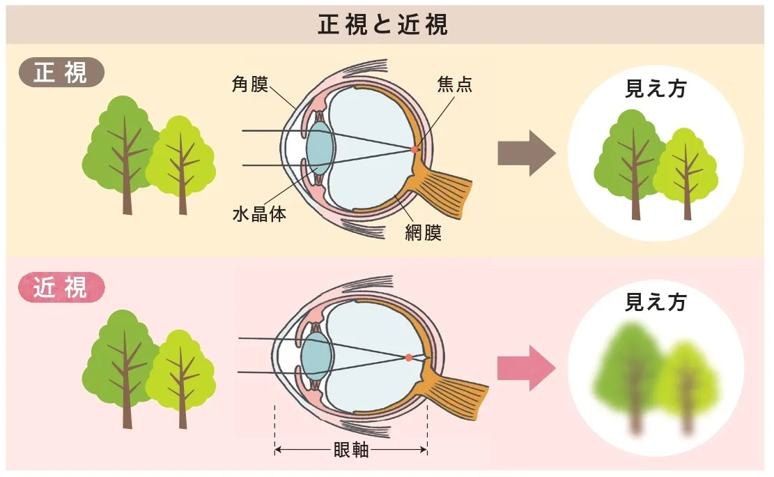 正視と近視