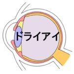 ドライアイ
