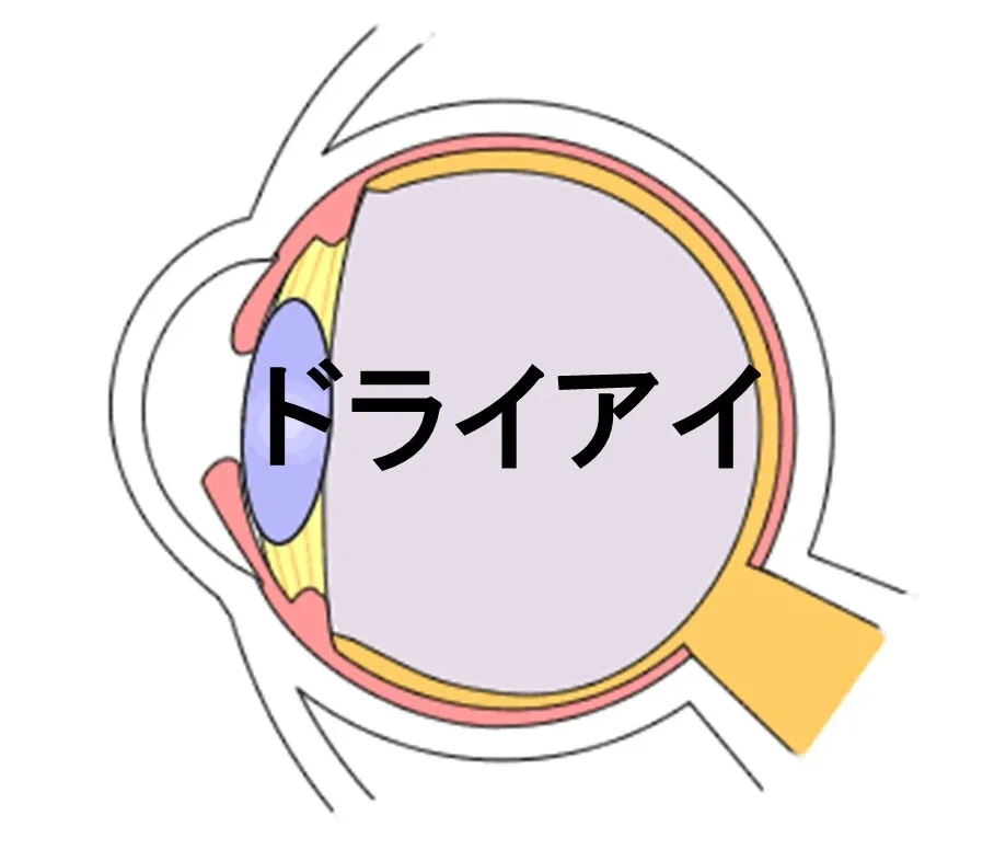 ドライアイ
