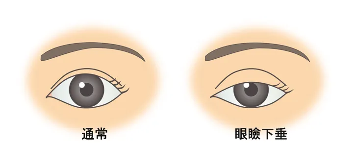 眼瞼下垂とは